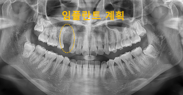  하남미사임플란트 제가 생각하는 네비게이션 임플란트 장점