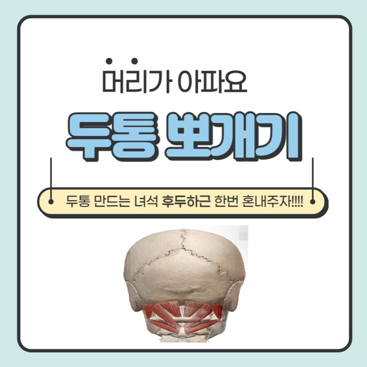  타이레놀 소용없는 두통을 후두하근 한번 혼내주자!! (하)