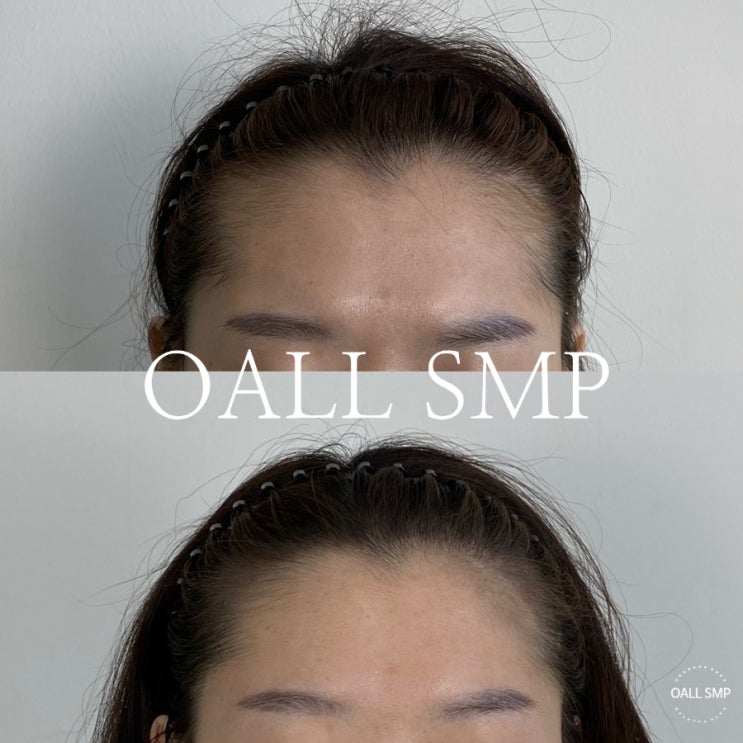  [OALL Scalp studio] 여성 자연스러운 그라데이션 헤어라인 SMP!