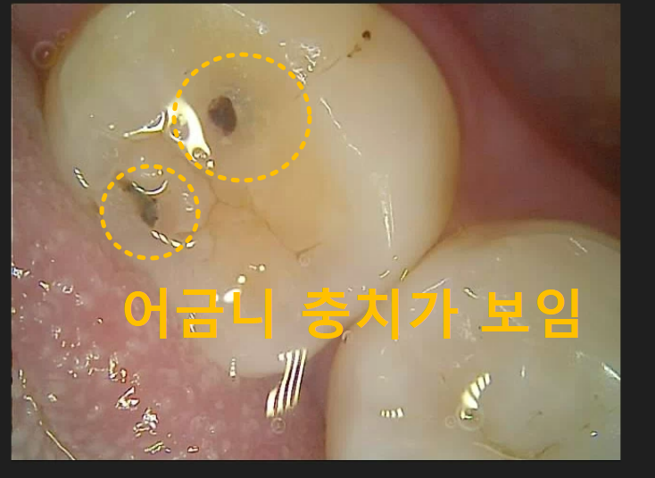  미사역 치과 어금니 충치를 레진으로