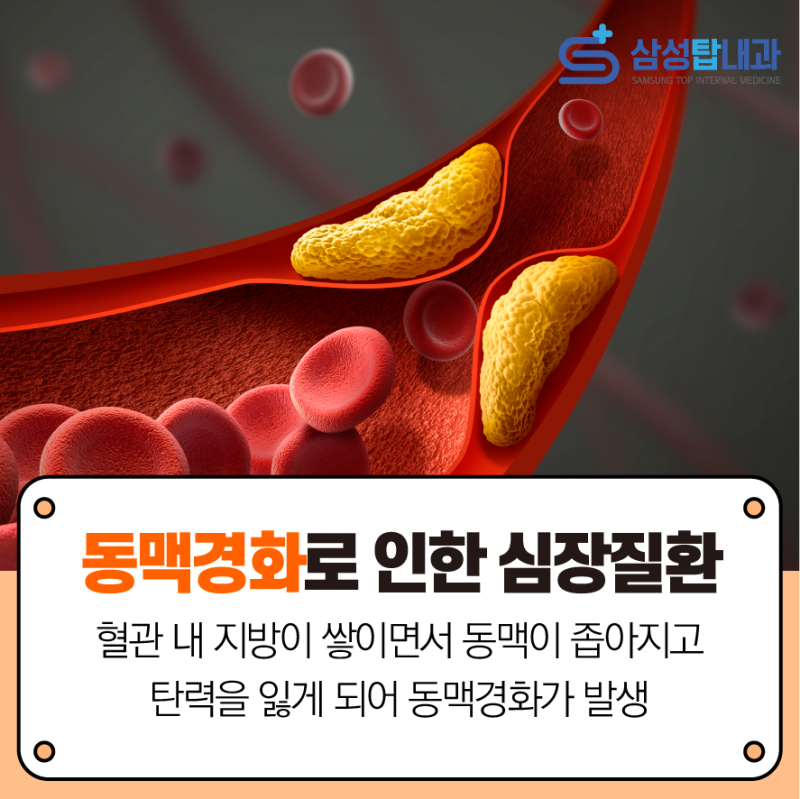 고지혈증 증가, 방치하면 뇌졸중, 심근경색 등 심각한 합병증 위험이 높아집니다. (일산365온가정의학과의원)