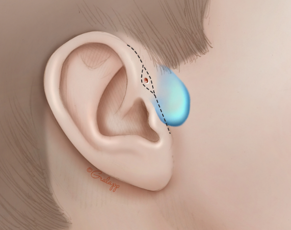 이개(auricle, 귓바퀴) 질환 - 외상, 감염과 염증, 선천성 이개전부 누공(Congenital preauricular ...