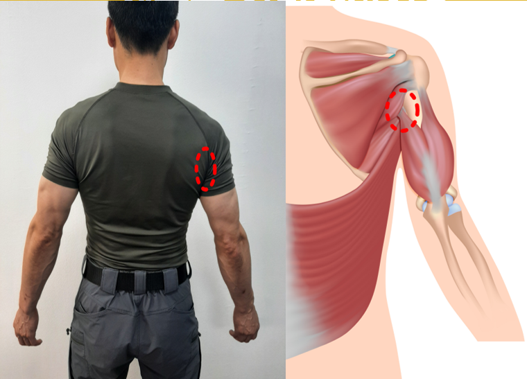 어깨후면 어깨통증이나 결림 해결은 삼두근 근육기능회복운동으로 여의도역체형교정 : 네이버 블로그