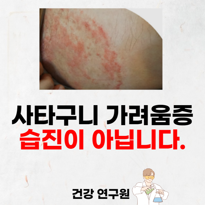 백선연고 (ft.사타구니가려움증) : 네이버 블로그