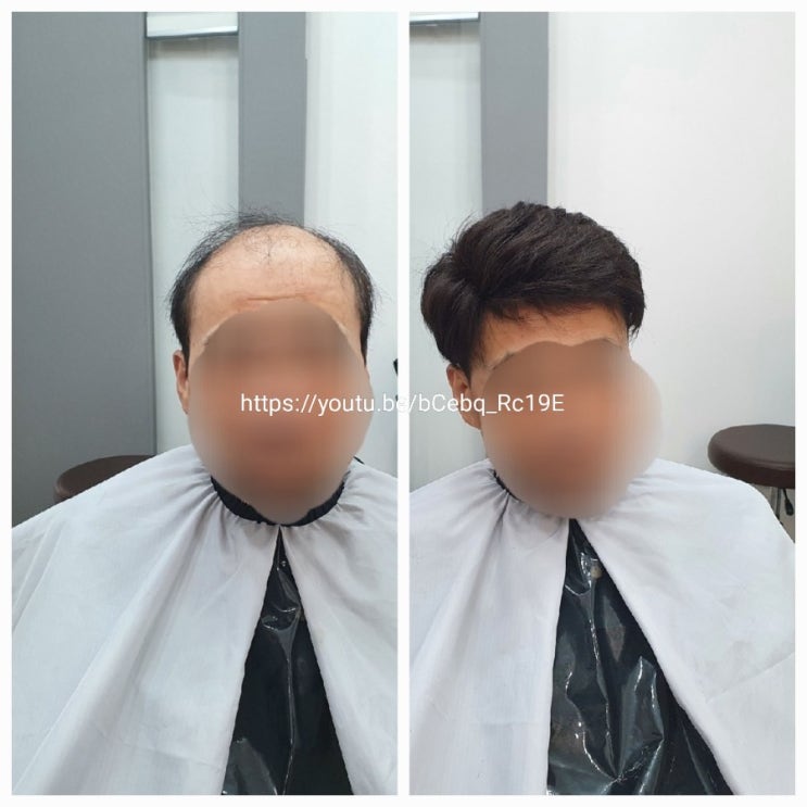  클립이 어렵다면? 벨크로 어때️ 모발에 붙이는 가발️ (춘천가발/ 춘천가발전문점/ 김호증모가발)