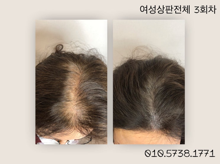  연산동 SMP두피문신, 자신감을 채우다!