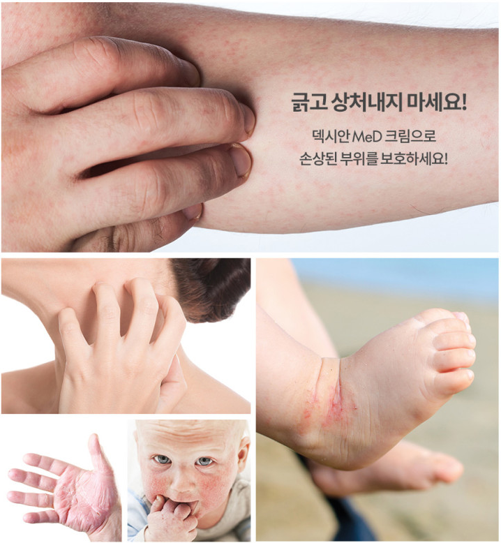  피부 가려움증 피부건조증 아기아토피 피부 덱시안메드크림 추천 내돈내산