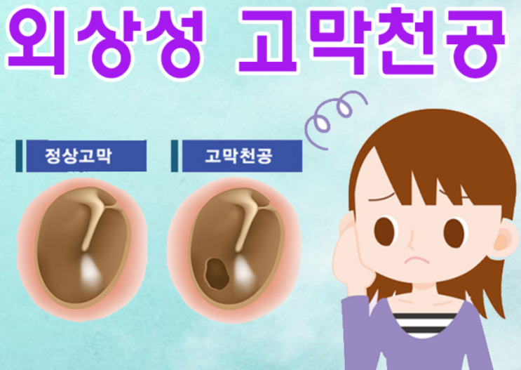  고막(Tympanic membrane)의 질환 - 외상성 고막 천공, 수포성 고막염, 육아성(육아종성) 고막염