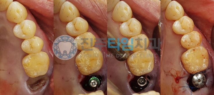  크랙으로 인한 발치, 발치 일주일후 임플란트 식립