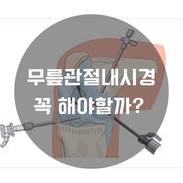  무릎관절내시경수술 꼭 해야할까?