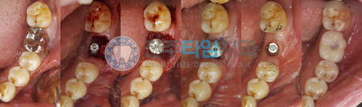  치근파절 후 발치즉시 임플란트 & 골치유 과정