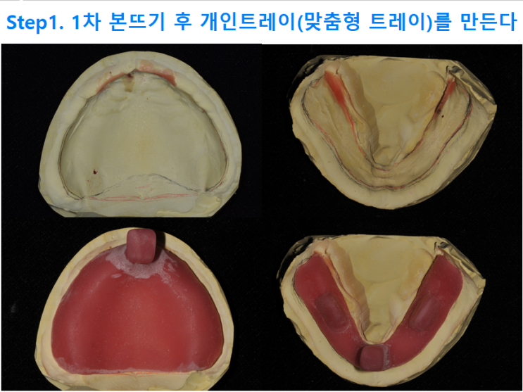 하남미사치과 틀니 제작되는 과정은?