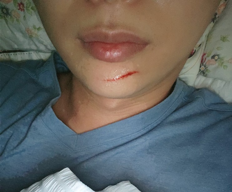 고양이 발톱 일격에 당함 고양이 발톱 일격에 당함