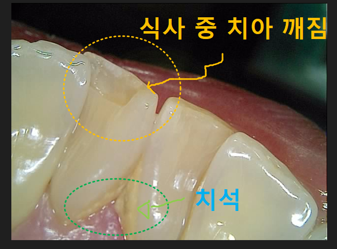 미사 망월동치과 밥먹다가 아래 앞니가 깨졌을 때 레진치료