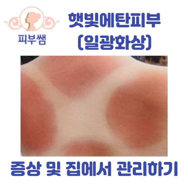  햇빛에 탄 피부(일광화상) 증상 및 집에서 관리하기