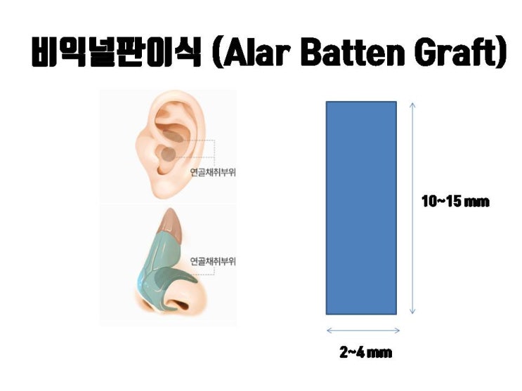  용코, 비익널판지이식으로 간단히 교정해 보는 게 어떨까요?