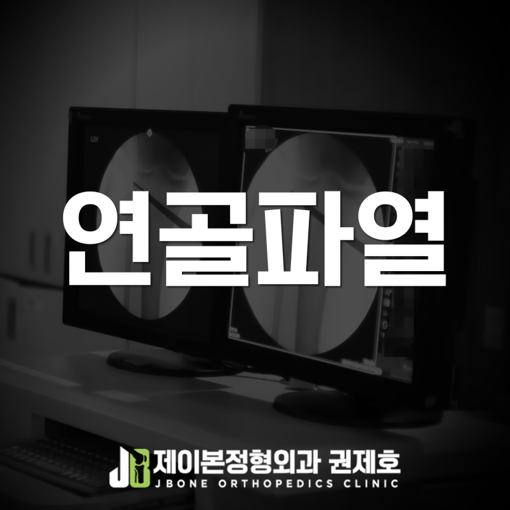무릎 연골판 찢어짐! 다시 러닝 가능할까요? feat. 제이본정형외과 권제호