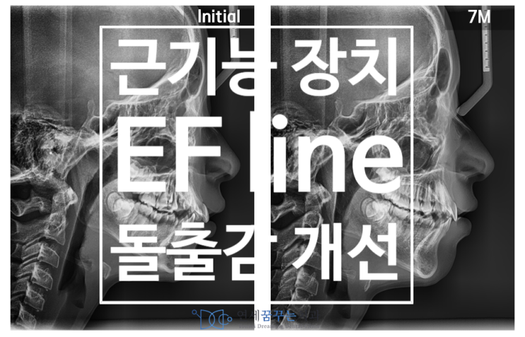 EF line으로 돌출감 개선하기, 근기능장치 효과