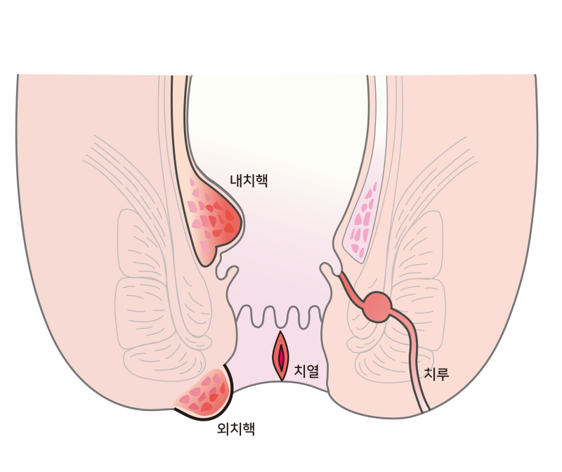 항문소양증 치료 원인에 따라 다르기에 5