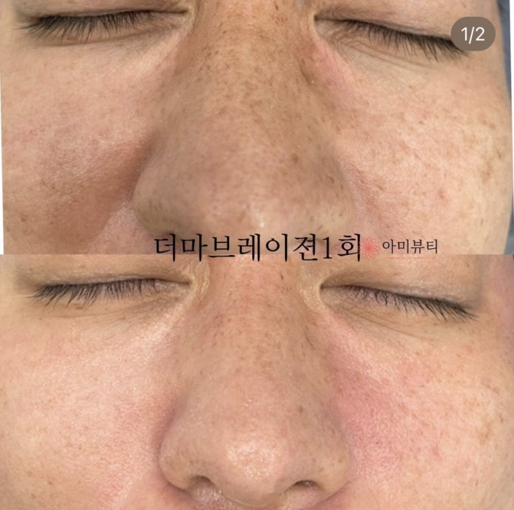  대구아미뷰티 블랙헤드 모공수축 물광피부 원하시면 더마브레이젼 시술이 최고에요 첫방문 50%할인!!