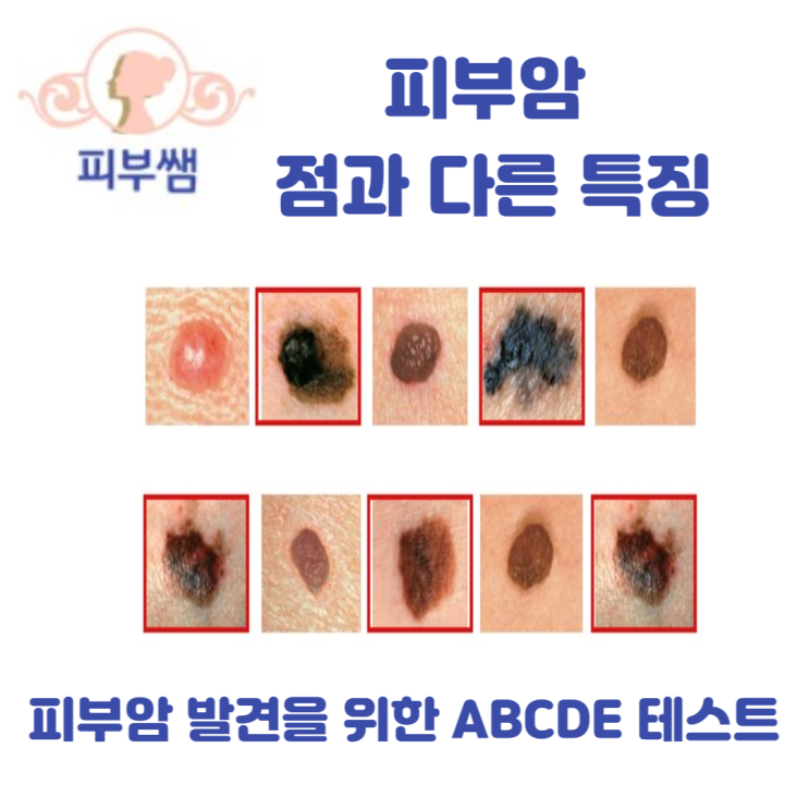 피부암 점과 다른 특징 피부암 발견을 위한 ABCDE 테스트