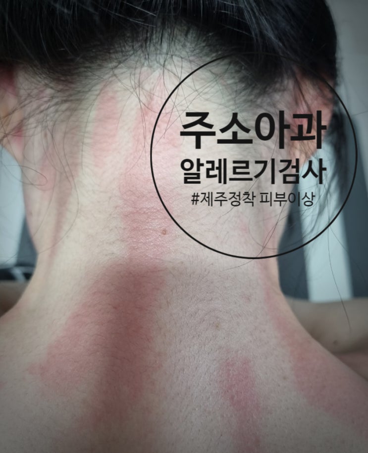  제주 주소아과 제주 알레르기검사 후기. (제주정착 후 피부알레르기)