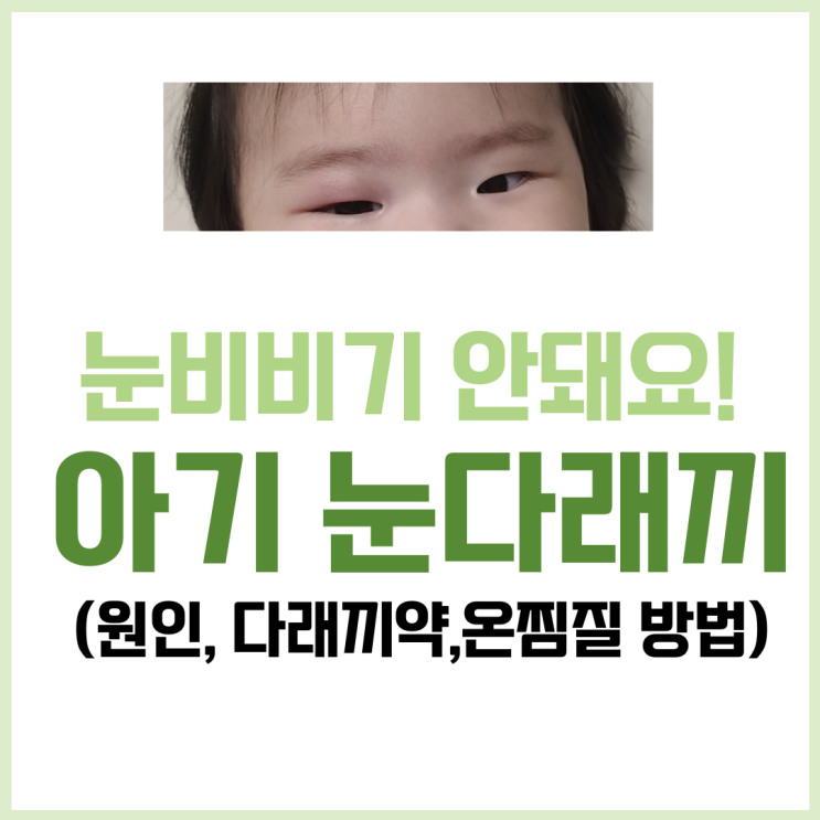  아기 눈비비기 다래끼 원인이 돼요. 아기 눈부음, 눈다래끼 약, 온찜질 방법