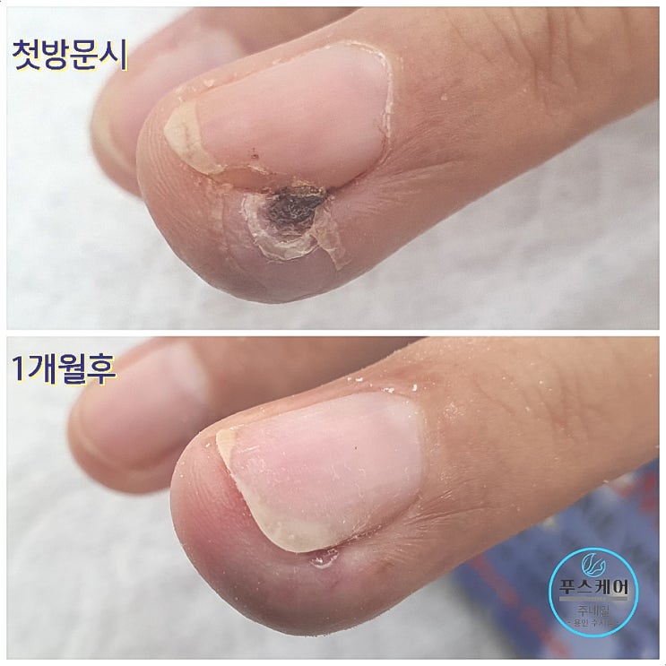 파고드는손톱때문에 40년을 조갑주위염으로 아픔으로 지내신 60대 여성분의 1달 2회 관리후기 /성남수원수지보정동백죽전동/주네일/네일샵무좀파고드는내향성발톱손톱변형푸스케어 파고드는손톱때문에 40년을 조갑주위염으로 아픔으로 지내신 60대 여성분의 1달 2회 관리후기 /성남수원수지보정동백죽전동/주네일/네일샵무좀파고드는내향성발톱손톱변형푸스케어