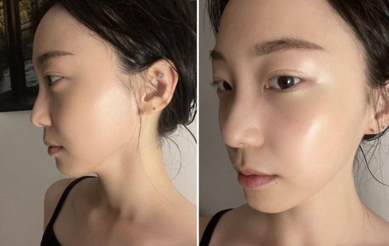 강남피부과 씨미잡티레이저후기 (엑셀브이레이저효과)