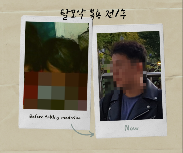  탈모약처방 사진 한장으로 종결