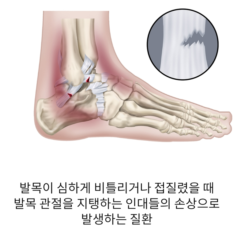 [노량진한의원]발목염좌 발목 삐끗 인대손상 발목접지름 발목염좌의 종류와 손상정도 : 네이버 블로그