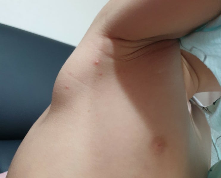  아기 수족구 잠복기, 증상 및 수포, 연고