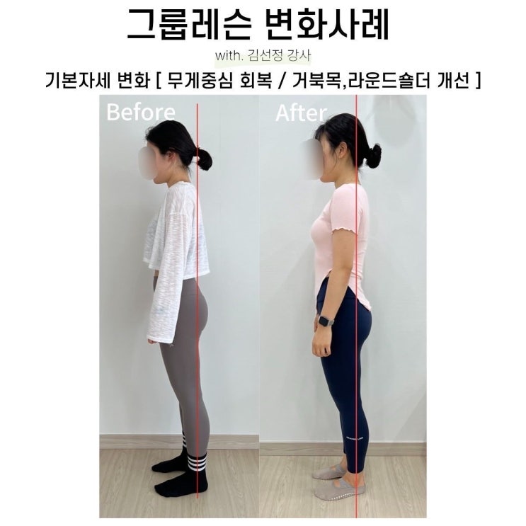 [대구SNPE] 거북목, 라운드숄더 개선 변화사례