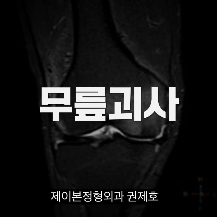 무릎골괴사증, SONK 무엇인가? 제이본정형외과 권제호