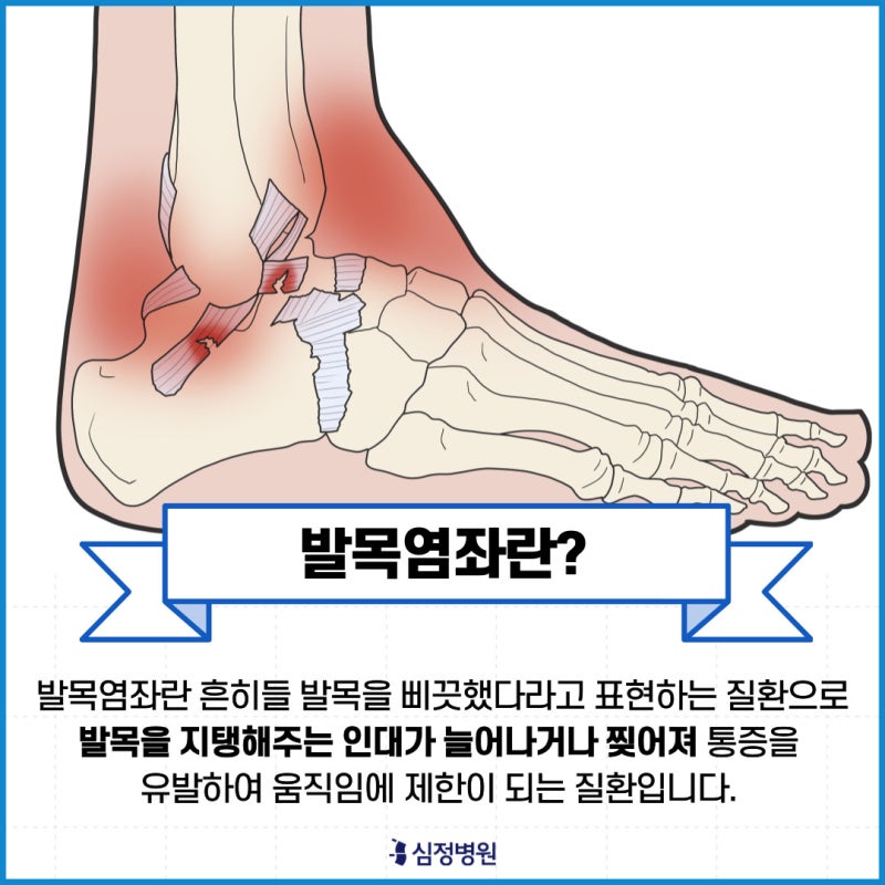 발목 인대 염좌의 4가지 증상, 응급처치, 회복 기간 및 방법