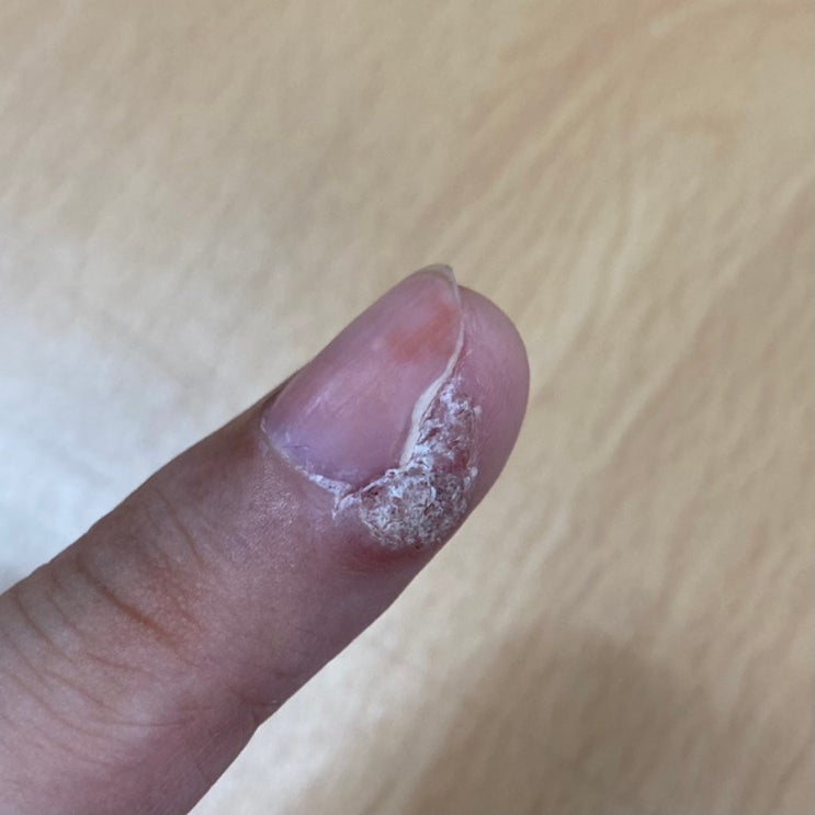  손가락 사마귀 치료 후기 (베루말 vs 레이저 치료 비교)