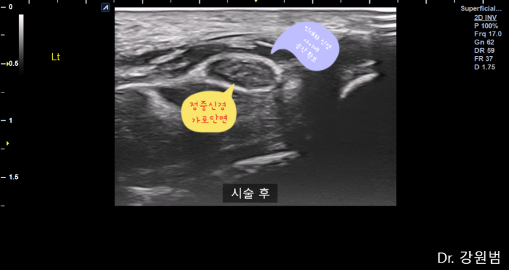  부산 손목터널증후군(수근관증후군) 제대로 치료하기