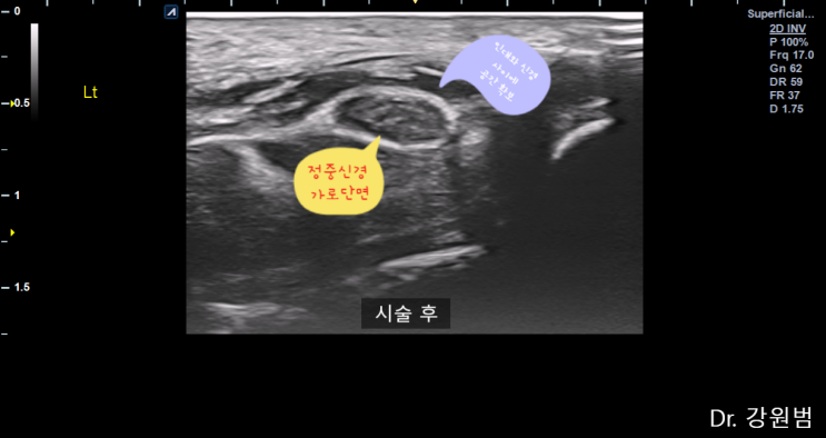 부산 손목터널증후군(수근관증후군) 제대로 치료하기