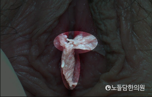 질 입구 돌기 뾰루지, 여자 곤지름 사진으로 비교 : 네이버 블로그