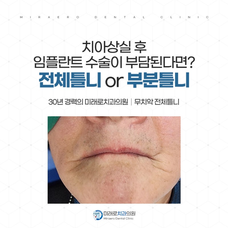 부산 틀니치과 전체 임플란트가 부담스럽다면 임플란트 틀니로!