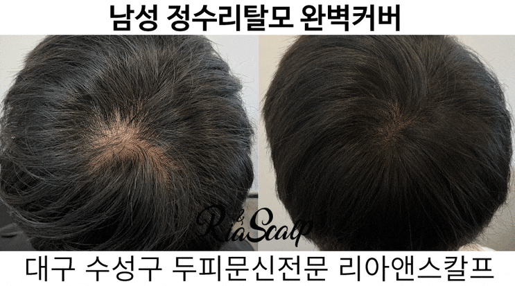  대구 두피문신 잘하는곳! 리아앤스칼프