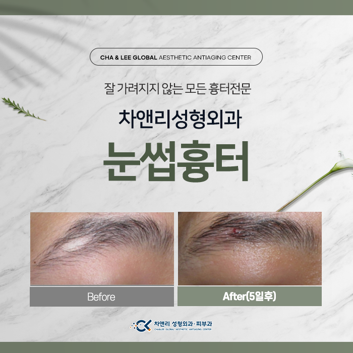  눈썹흉터, 머릿속흉터 모(毛)가 안난다면
