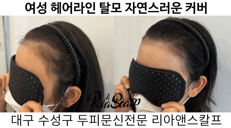  대구 두피문신은 리아앤스칼프에서 받으세요! 대구수성구두피문신전문샵