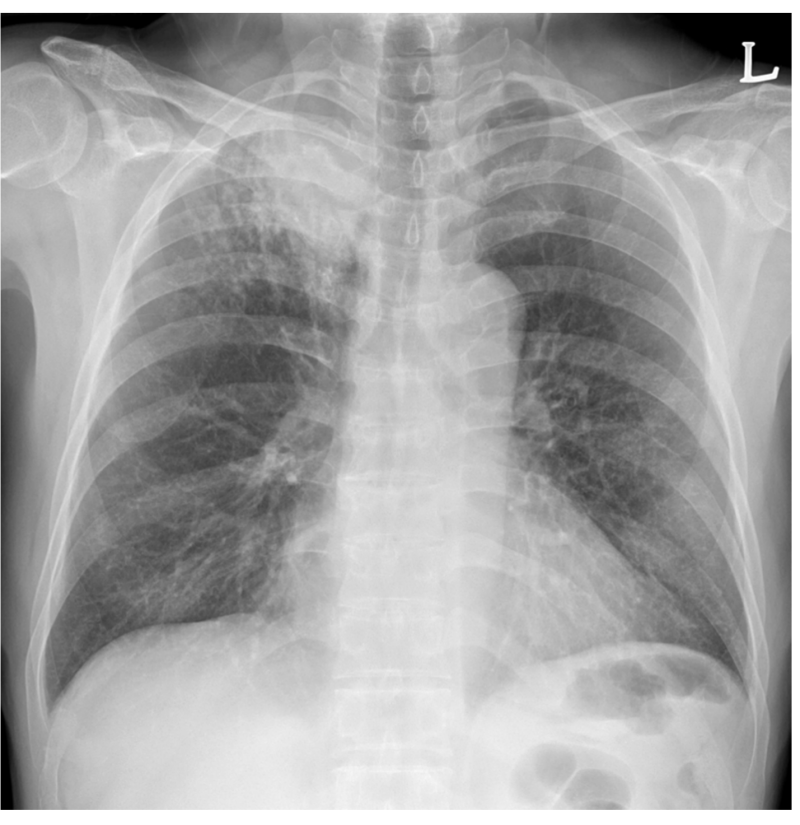 활동성 폐결핵 폐엑스레이 증례, 결핵 x-ray, 간유리음영, 폐경화 : 네이버 블로그