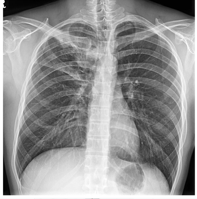 활동성 폐결핵 폐엑스레이 증례, 결핵 x-ray, 간유리음영, 폐경화 : 네이버 블로그