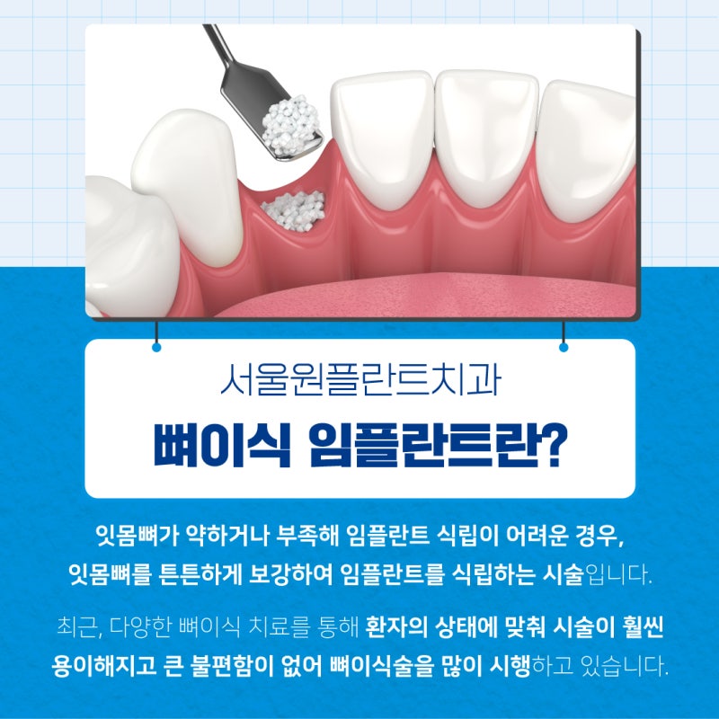 노원구 임플란트 뼈이식을 통해 튼튼한 치조골 확립 1