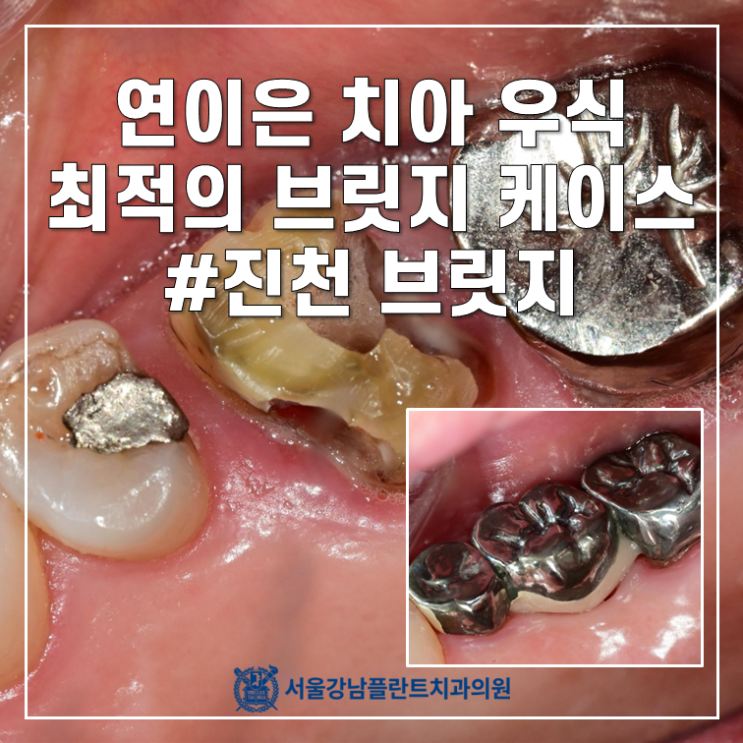  충치 옆에 충치, 또 그 옆에 충치 - 최적의 브릿지 케이스