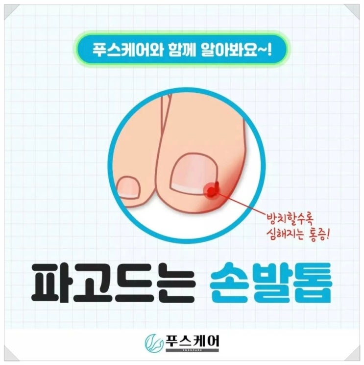 혹시 나도 내향성발톱? 파고드는발톱은 왜 생기는 걸까요?ingrown toenail/성남수원수지보정동백죽전동/주네일/네일샵무좀파고드는내향성발톱손톱변형푸스케어