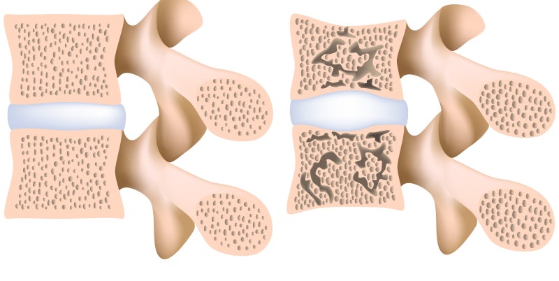 40대와 50대 여성 고유의 요통이란 1