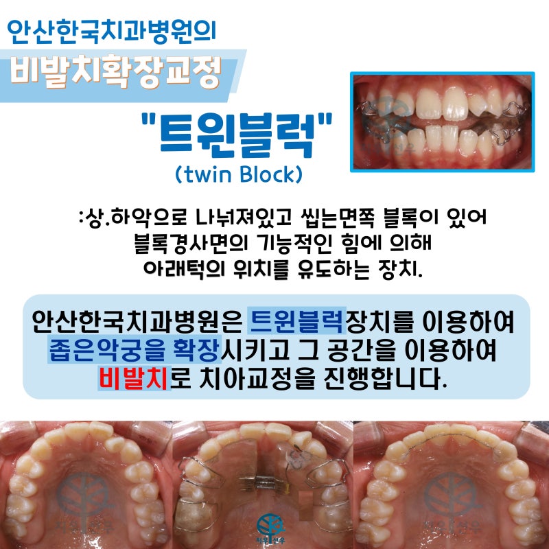 어린이부정교합치아교정 치과진단검사 치료시기